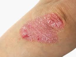 Apa itu Psoriasis?